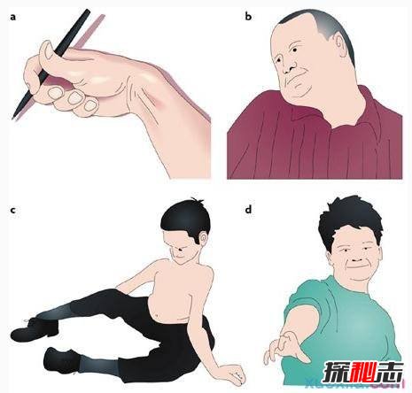 中國世界首例舞蹈豬,亨廷頓氏舞蹈癥是什么病?